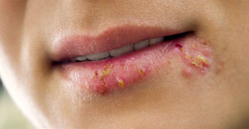 Detalles de la transmisión herpes