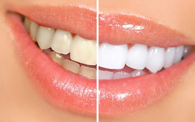 Razones por las que hacerse un blanqueamiento dental